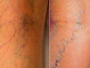 Dos imágenes de la cara posterior de la pierna. En la izquierda, una red de telangiectasias rojas finas en abanico que confluye hacia un tronco azulado más profundo; en la derecha, una vena reticular tortuosa, azul verdosa, de calibre claramente mayor, discurriendo bajo la piel. La segunda es la vena nutricia de la primera, y ese es el motivo por el que esclerosar solo la telaraña roja hace recidivar el cuadro. Manual de Escleroterapia, figura 1.